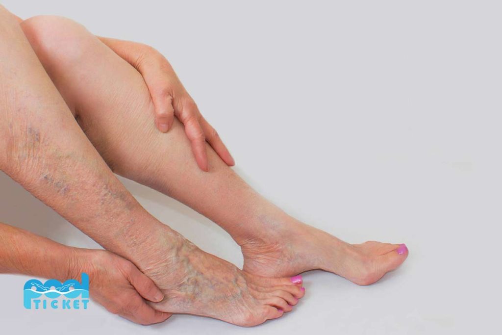 varicose veins